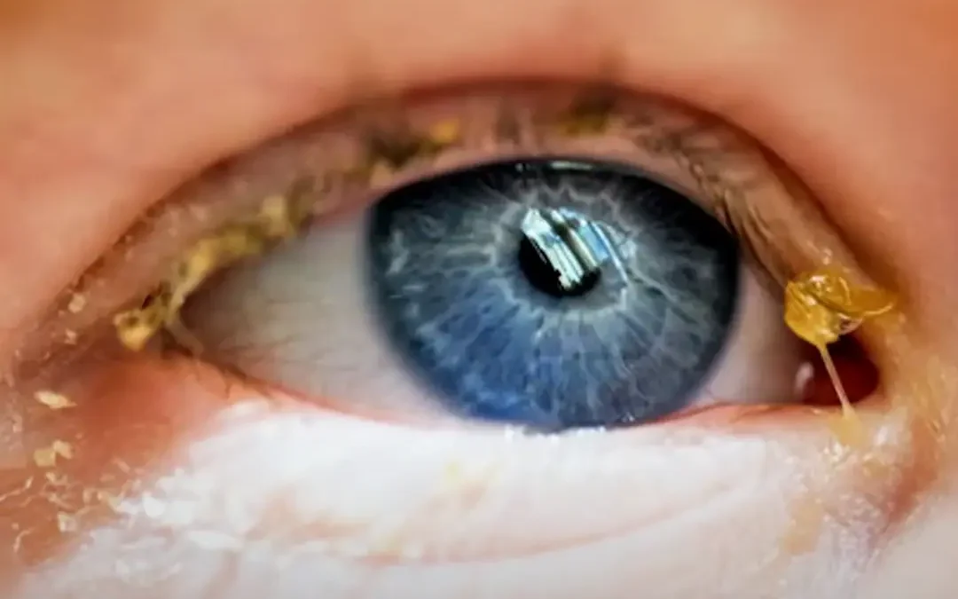 Legañas en los ojos: ¿Qué son y cuándo preocuparse?