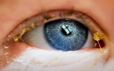 Legañas en los ojos: ¿Qué son y cuándo preocuparse?