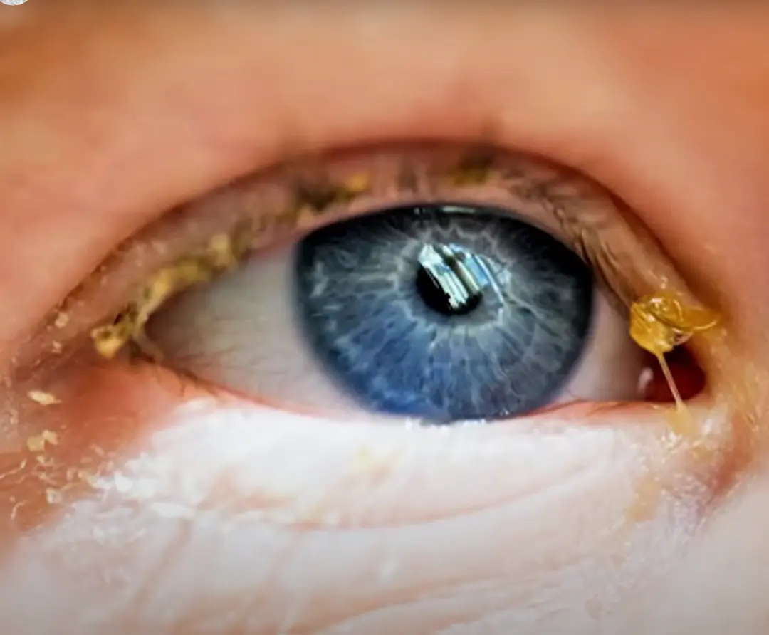 legañas en los ojos legañas en los ojos